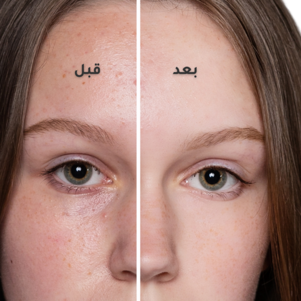 Salicylic Acid 2% Solution