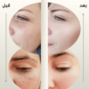 Peeling Solution