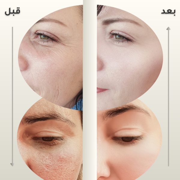 Peeling Solution